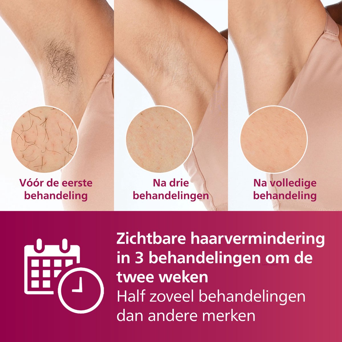 Philips Lumea Advanced IPL Ontharingsapparaat: Effectieve Haarreductie met 2 Opzetstukken BRI921/00