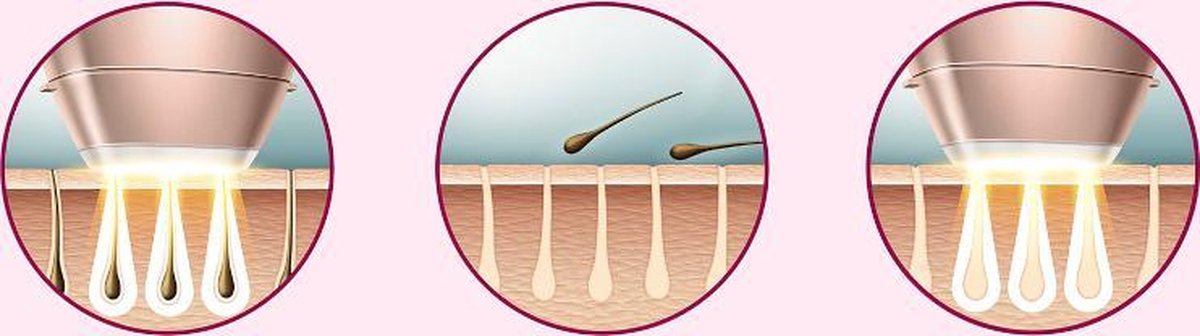 Philips Lumea Prestige 8000 IPL Ontharing: Effectieve Haarvermindering met 4 Opzetstukken