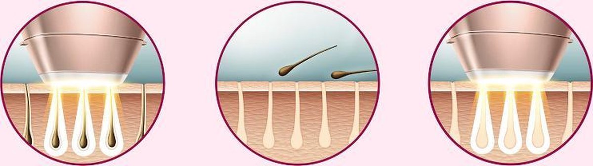 Philips Lumea Prestige 8000 IPL Ontharing BRI949/00: Effectieve Haarvermindering met 4 Opzetstukken - MR commerce